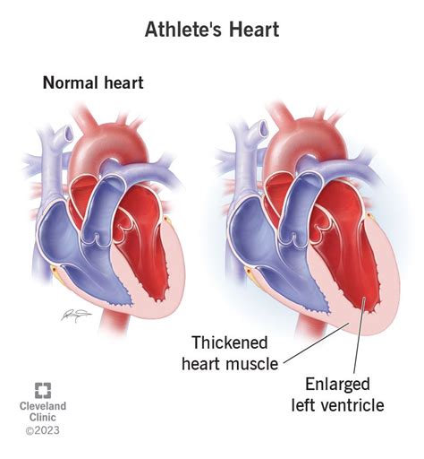 left ventricular hypertrophy athlete's heart